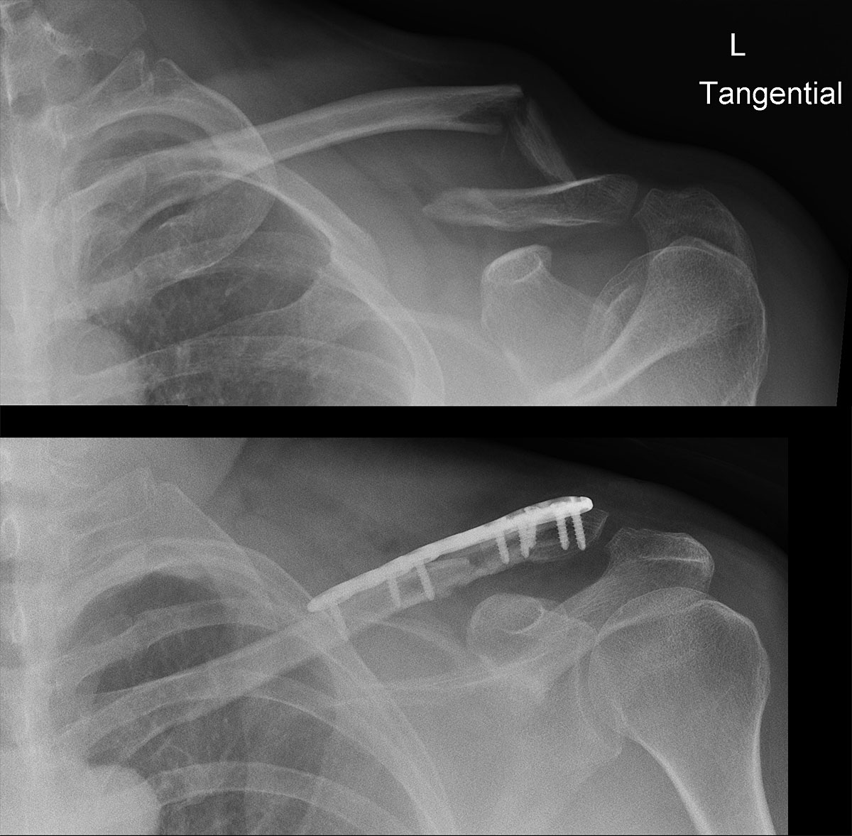 skiunfall-schluesselbein-blogbeitrag