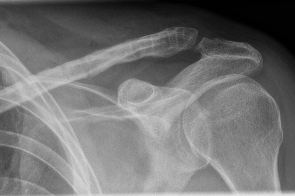 skiunfall schluesselbeinbruch clavicula stryker platte 001 skiunfall schluesselbeinbruch claviculafraktur styker platte roentgenbild schulter heilung schluesselbein